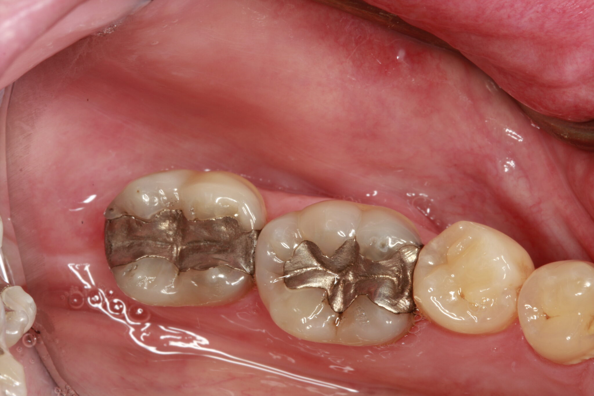 Porcelain Crown Vs. Metal Crown Making an Informed Decision