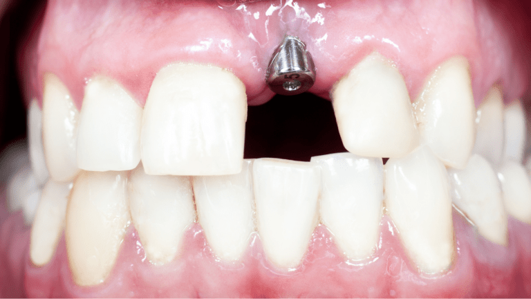Read more about the article What Are Dental Implants & How Do They Work?