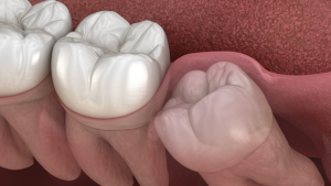 Wisdom Teeth Removal FAQ guide: 10 Most Common Questions