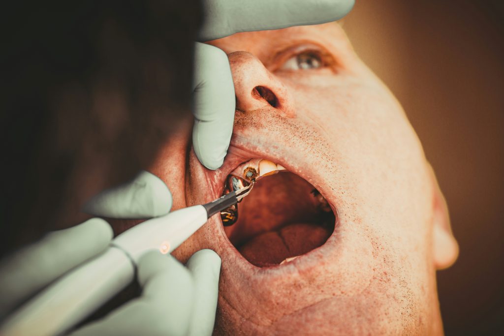 removing tooth stains